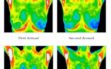 Breast thermography