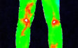 thermography - legs