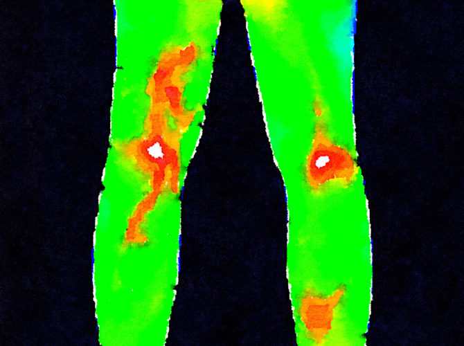 thermography - legs